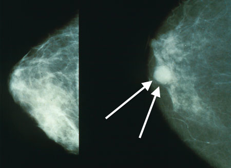 سرطان سینه