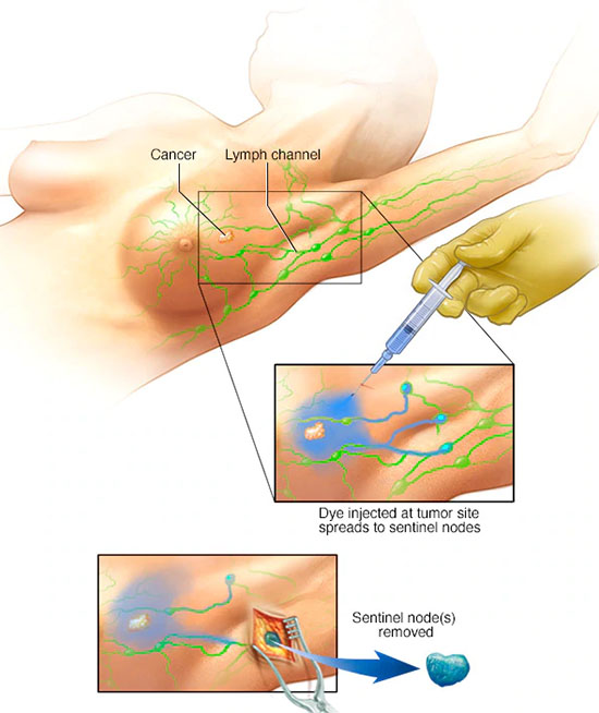 برداشتن برخی گره‌های لنفی در سرطان پستان - بایوپسی گره‌های ابتدایی