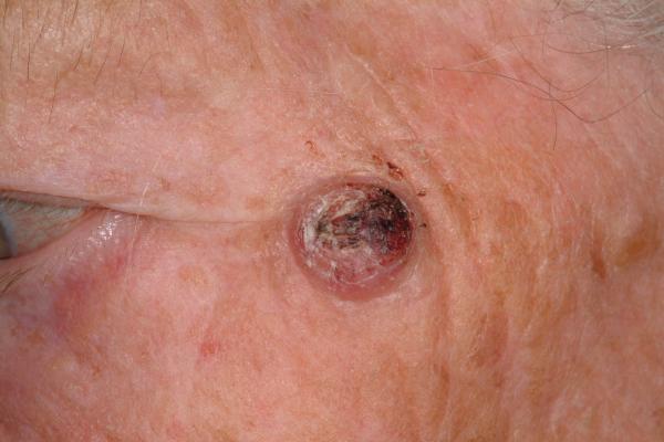 سرطان پوست کارسینوم سلول سنگفرشی