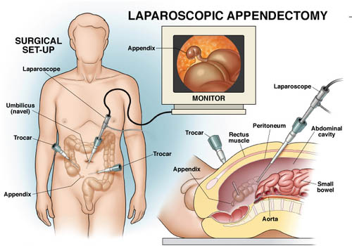لاپاروسکوپی