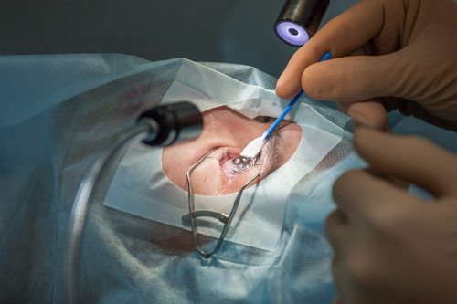 عمل و جراحی لیزیک چشم