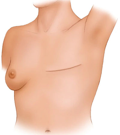 برداشتن سینه به طور کامل در سرطان پستان - ماستکتومی