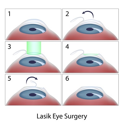 عمل جراحی لیزیک (LASIK)