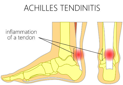 التهاب تاندون آشیل Achilles Tendonitis