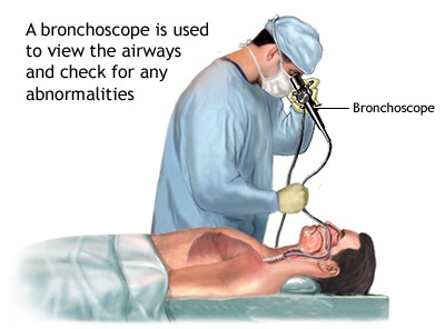 برونکوسکوپی برای تشخیص پنومونی