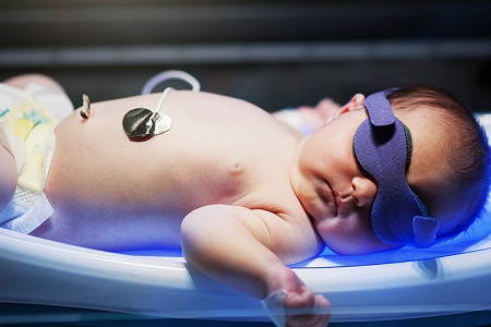 درمان زردی نوزادان با استفاده از نور درمانی