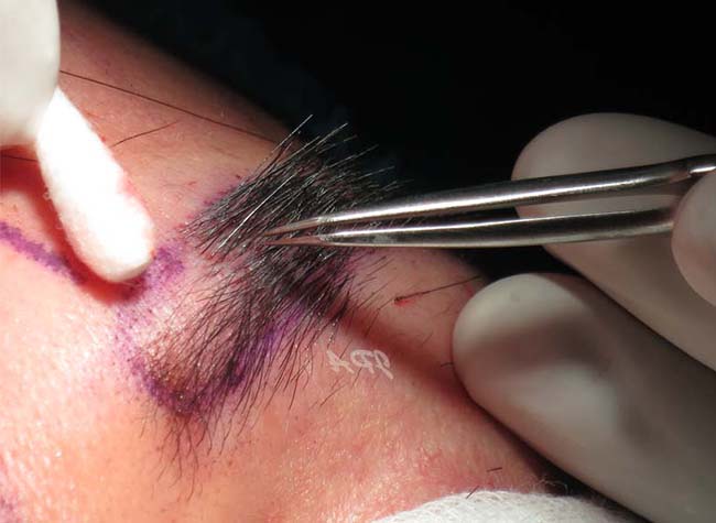 10 نکته مهم که باید قبل از عمل جراحی کاشت ابرو بدانید