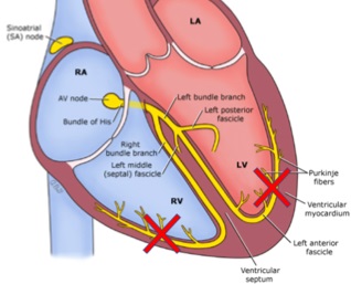 نمای قلب در بیماری بلوک قلبی 