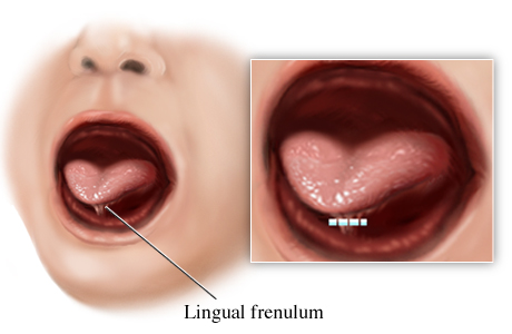 جراحی لکنت زبان 