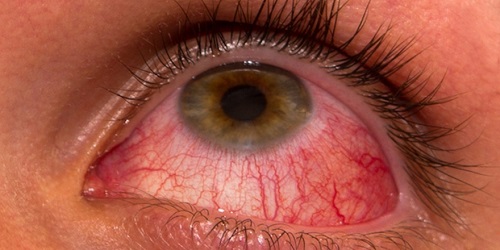 اثر بیماری بهجت روی چشم 