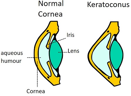 بیماری قوز قرنیه Keratoconus