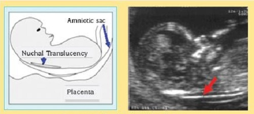 اندازه‌گیری ضخامت مایع پشت گردنی جنین در سونوگرافی دوران بارداری