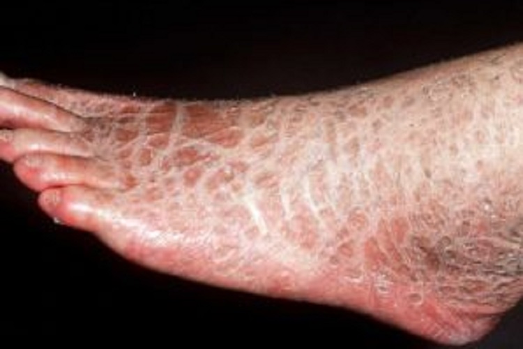 ایکتیوز Ichthyosis  یا خشکی شدید پوستی چیست
