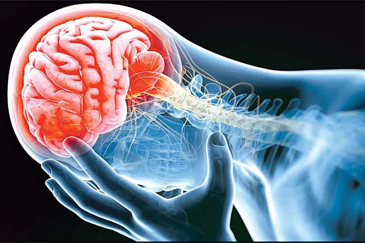 جراحی‌های مغز ممکن است به جلوگیری از سکته مغزی کمک کند