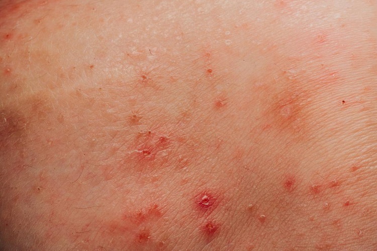 Herpes Or Genital Warts In Men And Women Causes And Treatment