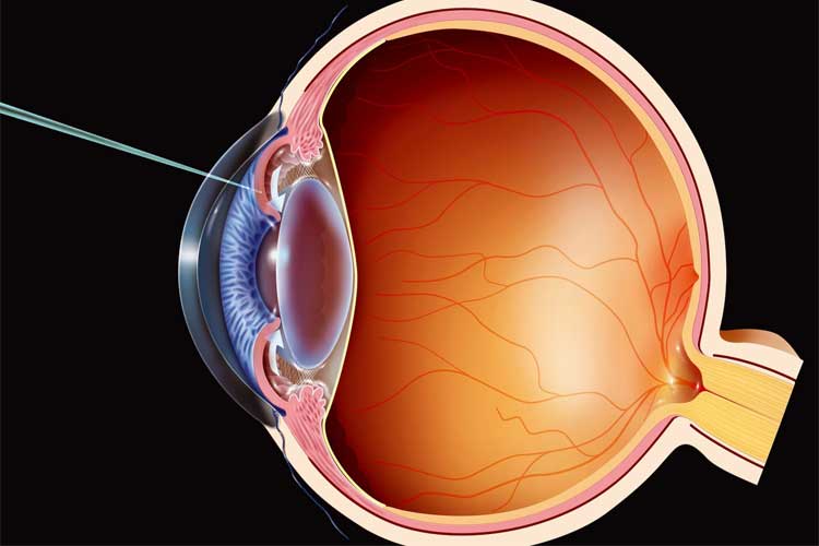 مروری بر جراحی‌های چشم، مقایسه آن‌ها و تائیر آن بر بینایی