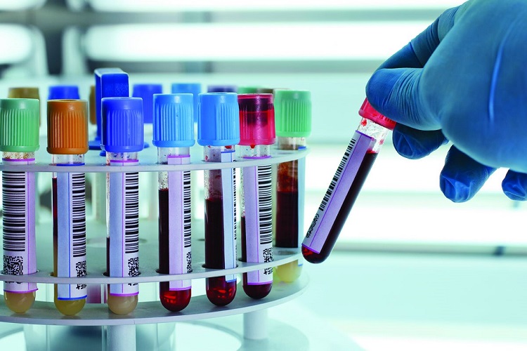هماتوکریت یا HCT  موجود در آزمایش خون چیست؟