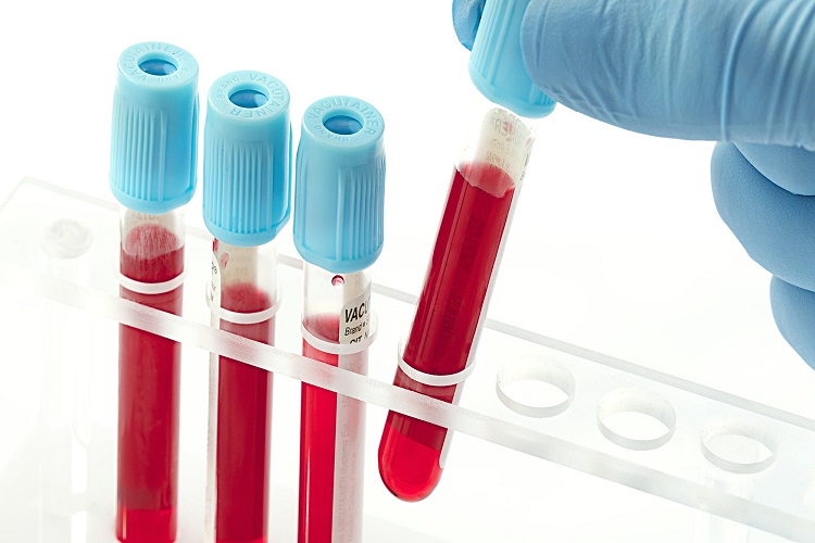 MCV در آزمایش خون نشانه چیست؟