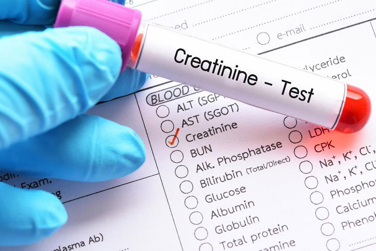 آزمایش کراتینین Creatinine چیست؟