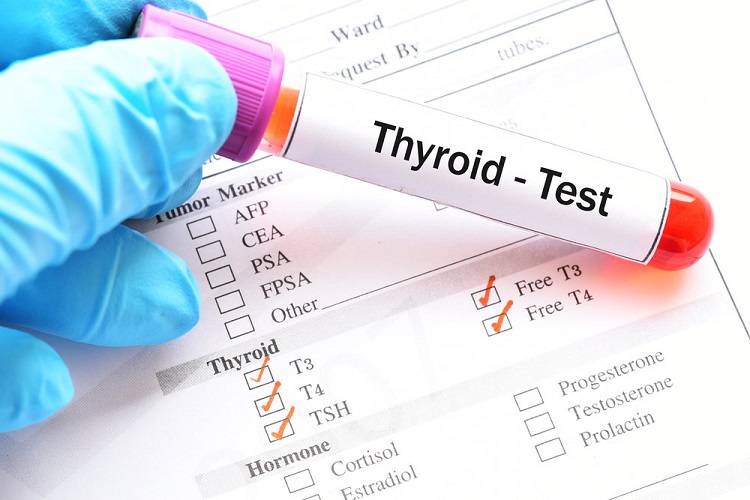 آزمایش TSH یا هورمون تحریک کننده تیروئید چیست؟