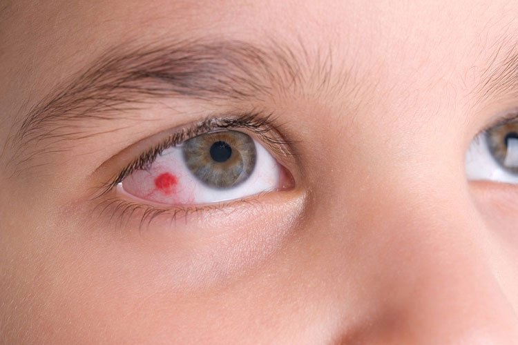 علت ایجاد لخته در چشم چیست و این حالت چگونه درمان می‌شود؟