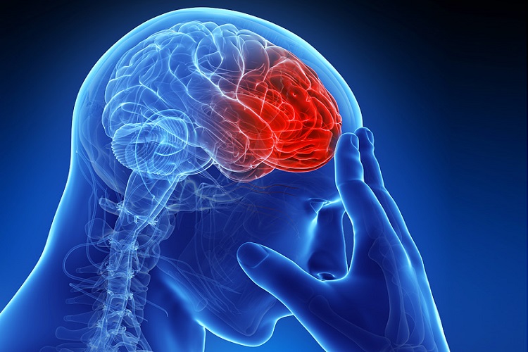 درباره سکته مغزی brain stroke، علائم و درمان آن‌ بیشتر بدانید