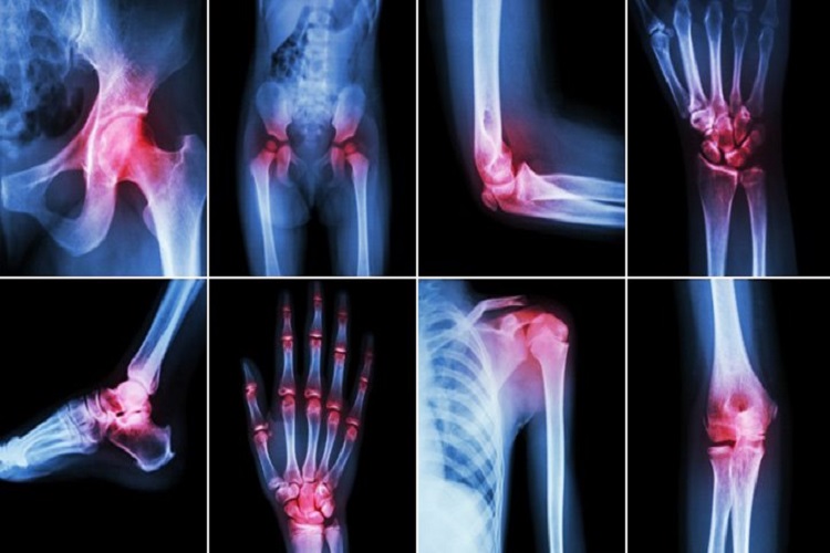 نگاهی به بیماری آرتروز Arthritis از علائم تا راه‌های درمان آن