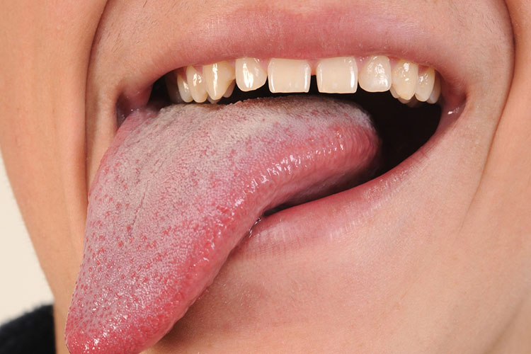 آشنایی با برفک دهان یا سفیدی روی زبان؛ از علائم و عامل ایجاد کننده تا درمان‌های خانگی و دارویی