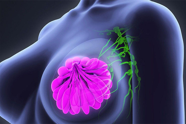 نگاهی به سرطان پستان؛ تشخیص، درمان و مراقبت