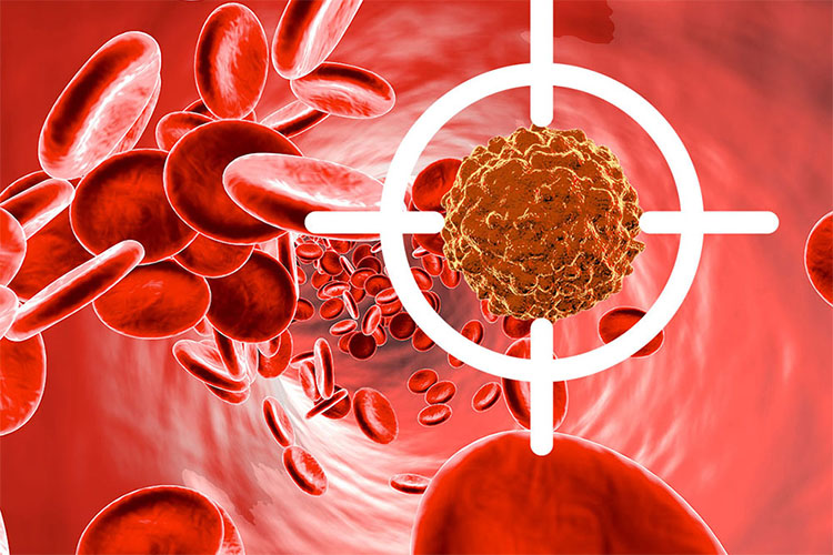 حقایقی در مورد سرطان خون و تحلیل بقای بیماران مبتلا به سرطان خون حاد میلوئید