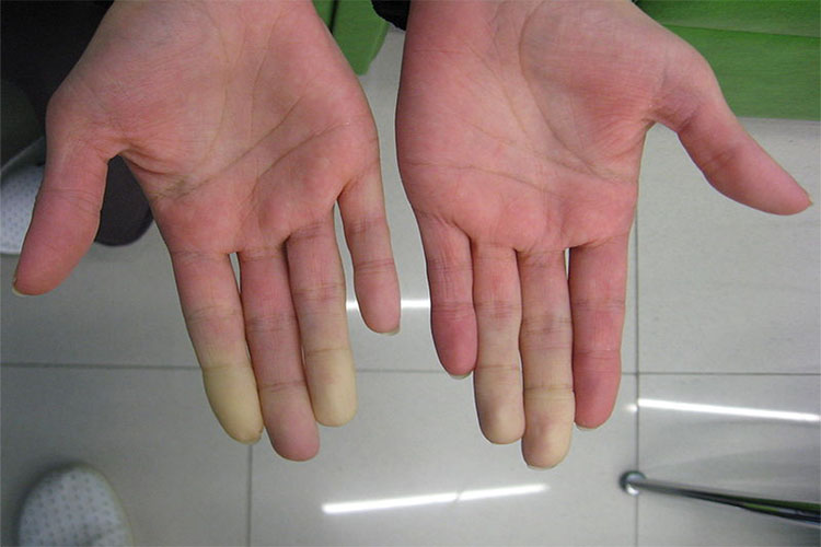 سندرم رینود و علت کاهش گردش خون در دست و پا