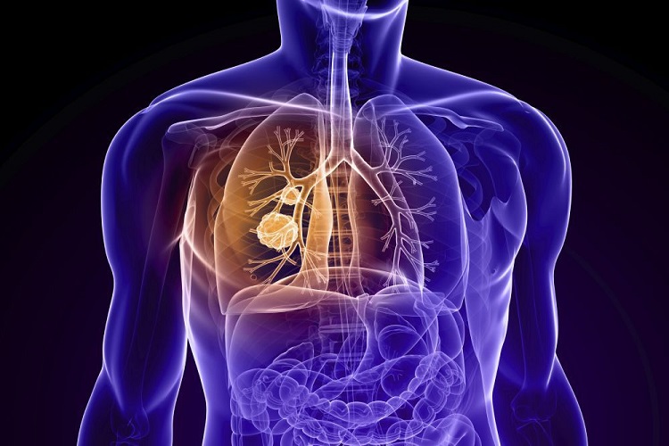 معرفی بیماری انسداد ریه COPD به همراه علائم و راه‌های درمان