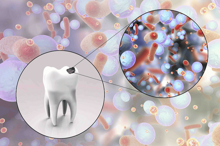 علت اصلی پوسیدگی دندان چیست و برای جلوگیری از آن چه باید کرد؟