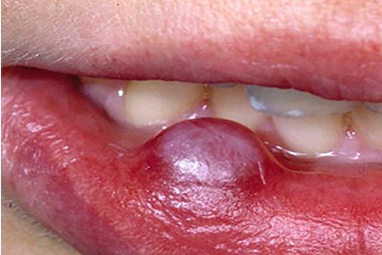 آشنایی با انواع کیست‌های فک و دهان mouth cysts به همراه راه‌های درمان