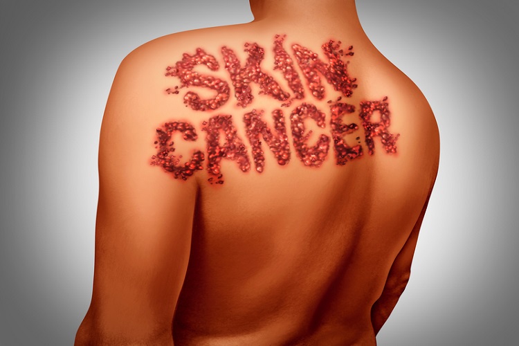 همه چیز درباره سرطان پوست Skin cancer