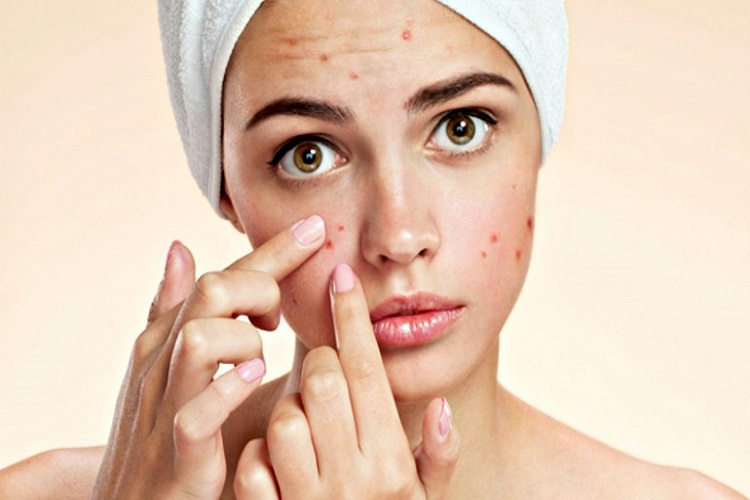نکات طلایی در مورد ضایعه پوستی آکنه acne به همراه درمان‌های دارویی