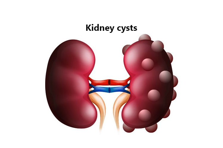 کیست کلیه Kidney cysts، از علائم تا راه‌های درمانی