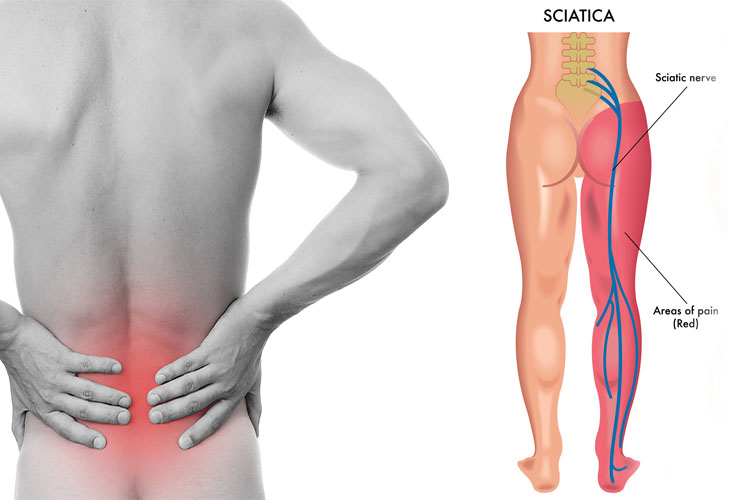 علت درد در ناحیه پا و کمر چیست و ارتباطش با درد سیاتیک یا سیاتالژی چه می‌باشد؟