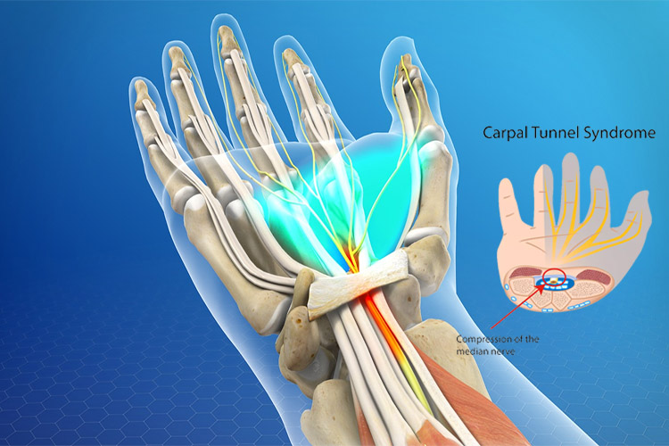 ارتباط درد و احساس سوزش در دست با سندرم تونل کارپال، به همراه روش‌های درمان آن