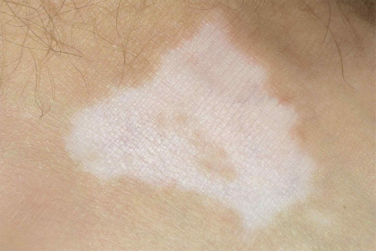 علت بروز لکه‌های سفید بر روی پوست چیست؟