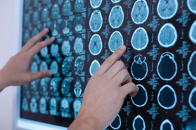 بررسی انواع تومورهای مغزی به همراه نحوه تشخیص بیماری و راه‌کارهای درمانی