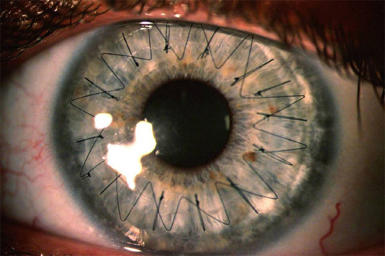 نکاتی مهم در رابطه با پیوند قرنیه چشم یا کراتوپلاستی