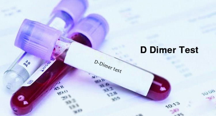 آزمایش دی دایمر یا تشخیص لخته خون چیست؟