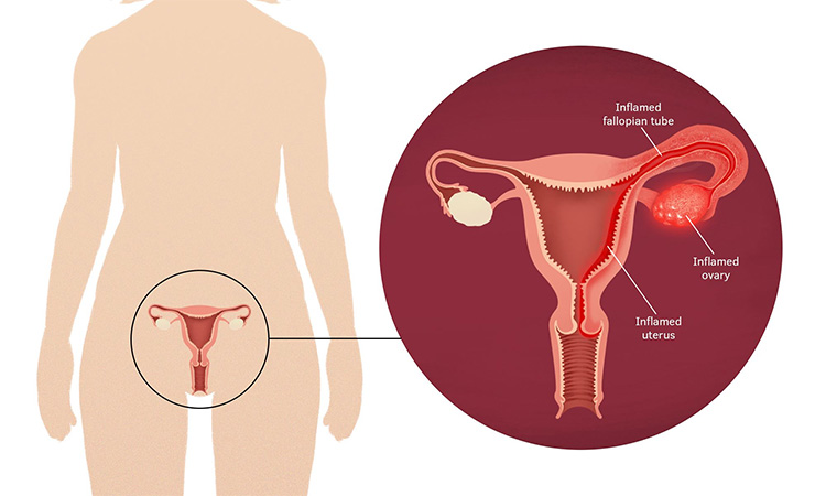بیماری التهابی لگن یا عفونت لگن در زنان چیست؟