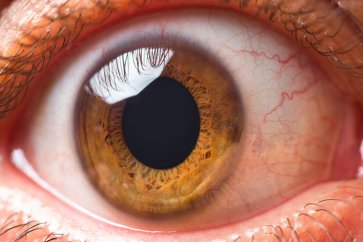 فلوتر چشم یا مشاهده اجسام و لکه‌های ریز شناور در بینایی افراد نشانه چیست؟