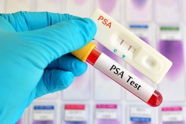 آزمایش پروستات یا تست PSA چیست؟