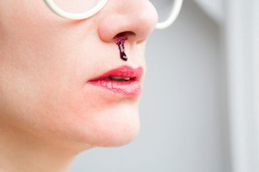 چه چیزی منجر به خون‌ریزی بینی می‌شود؟