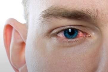 هشت نوع عفونت چشم و روش‌های درمان ‌آن‌ها