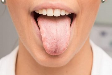 چرا به خشکی دهان دچار می‌شویم و چطور باید در این شرایط بزاق دهان را کنترل کنیم
