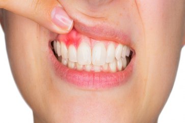 آبسه دندان Tooth abscess را جدی بگیرید